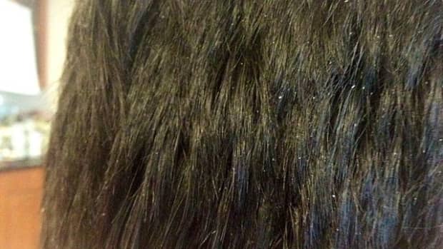 10-best-ways-to-get-rid-of-dandruff-naturally