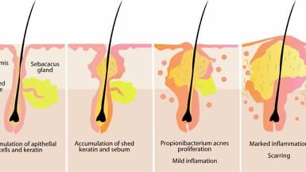 acne-vulgaris-what-is-it