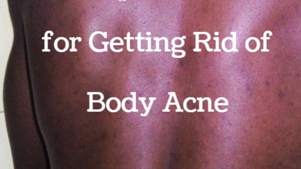 get-rid-of-body-acne-naturally-at-no-extra-cost