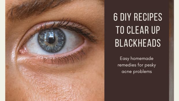 how-to-get-rid-of-blackheads-6-homemade-recipes-to-get-rid-of-blackheads