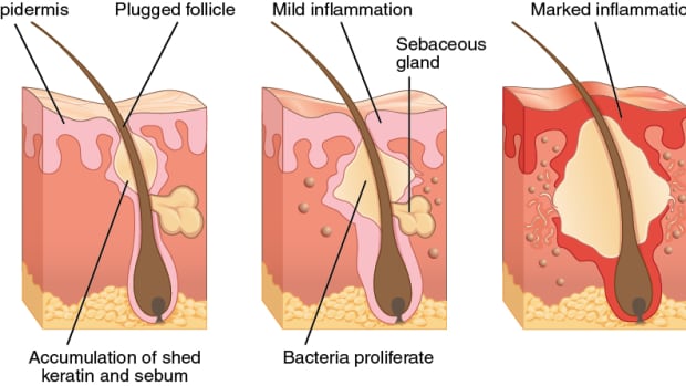 the-cure-to-acne