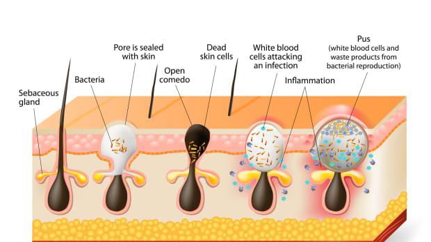 things-you-probably-didnt-know-about-acne